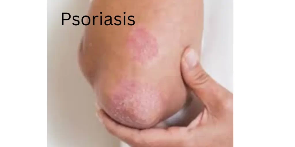 Psoriasis: Symptoms, Causes, and Treatment 