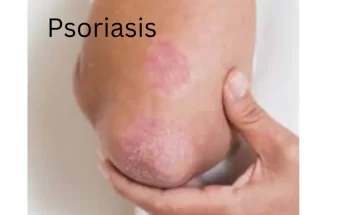 Psoriasis