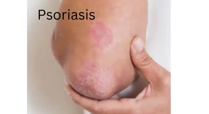 Psoriasis